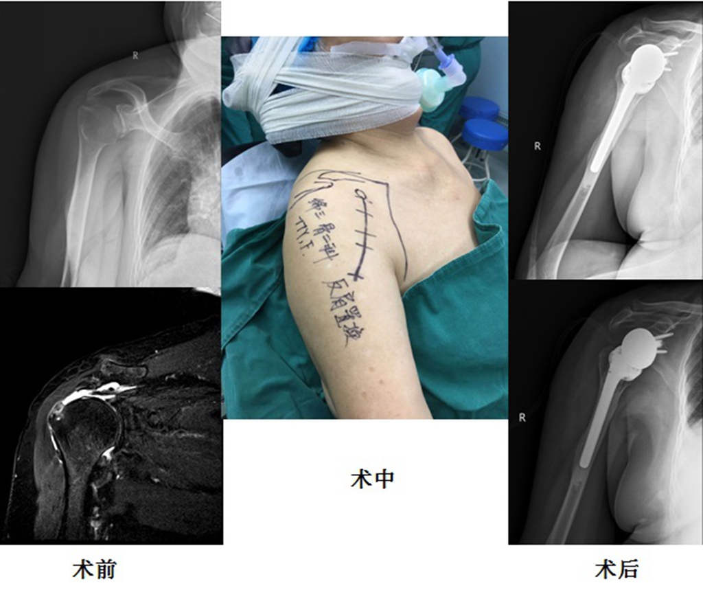 高新特急重系列报道：反式全肩关节置换术治好患者“报废”右肩