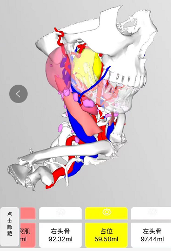 3D辅助     精准“拆弹”——我院甲状腺头颈颌面外科运用3D 技术精准定位切除咽旁肿瘤