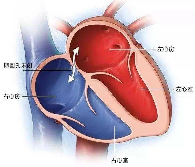 卵圆孔未闭｜这个“心眼”没长好，也成为神秘的健康“新”杀手