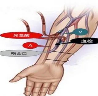 动静脉内瘘溶栓术 挽救透析患者“生命线”