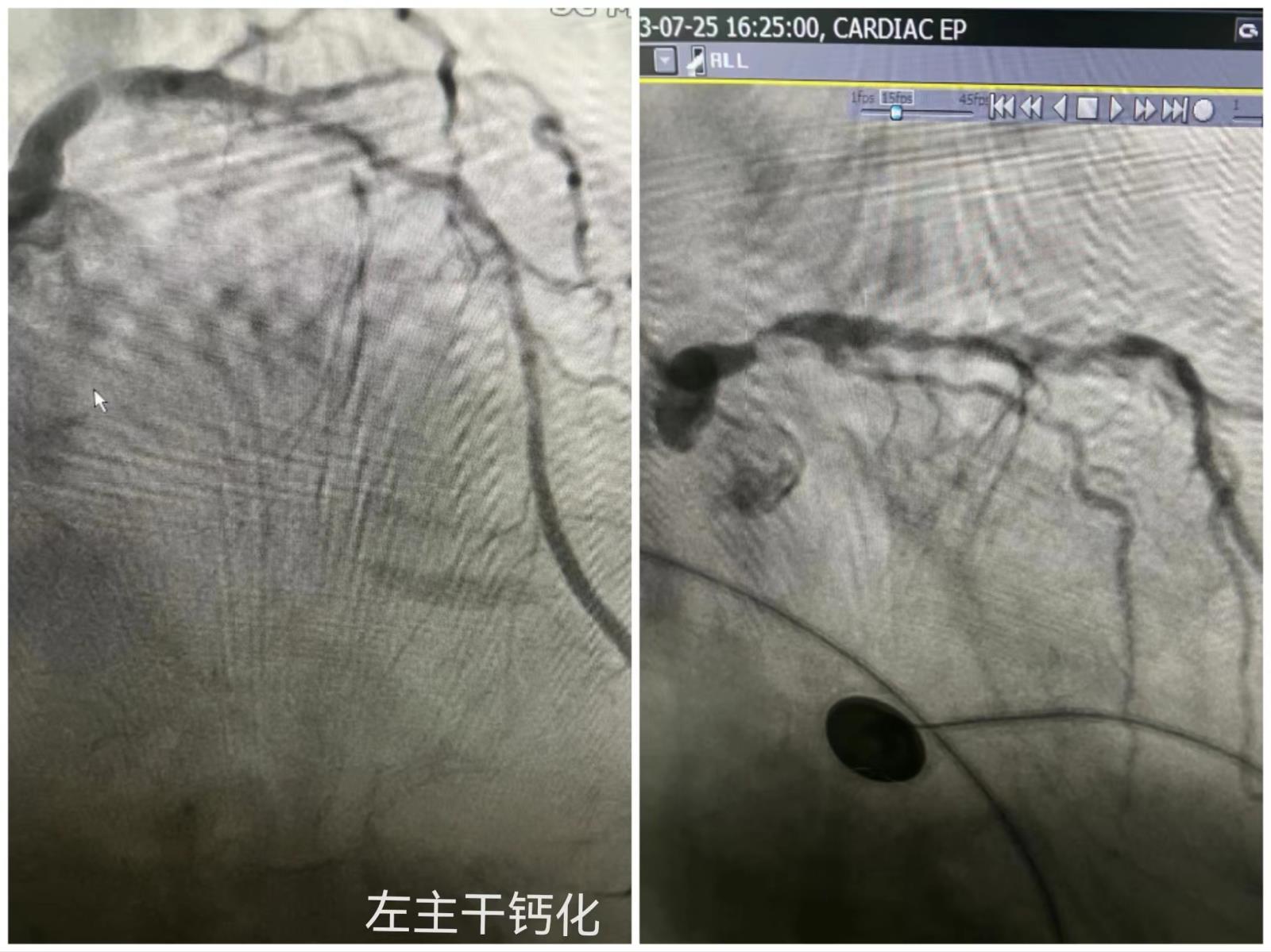 60岁大爷冠状动脉严重钙化，通过“微米钻石切割”旋磨术巧妙植入支架