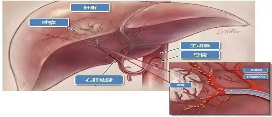 肝癌患者关注：肝脏血管介入治疗，这些知识点你都了解吗？