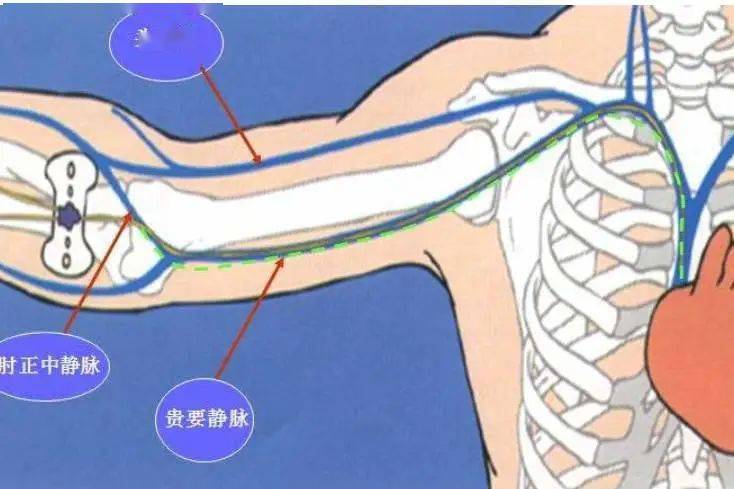 科普 | 危重病人有困难，中长导管来解决