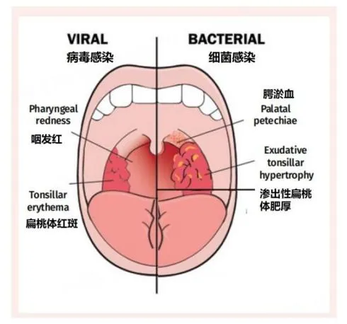 【科普】嗓子疼、嗓子痒是“三阳”、“甲流”、还是“咽喉炎”？你中招了吗？