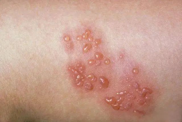 游仙分院：【中医助健康】带状疱疹怎么办？中医来支招！